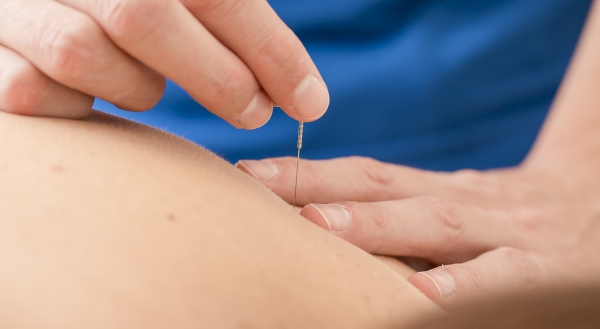 Dry Needling